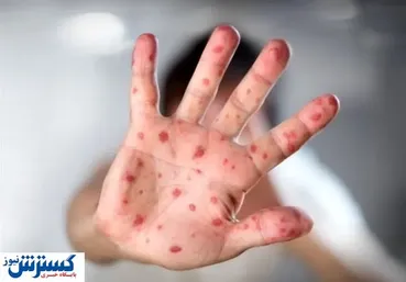 هشدار بیماری | اتباع افغان و پاکستان سوغاتی تازه آوردند !