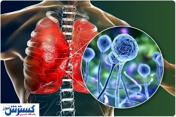 قارچ سیاه چیست؟ + راه درمان
