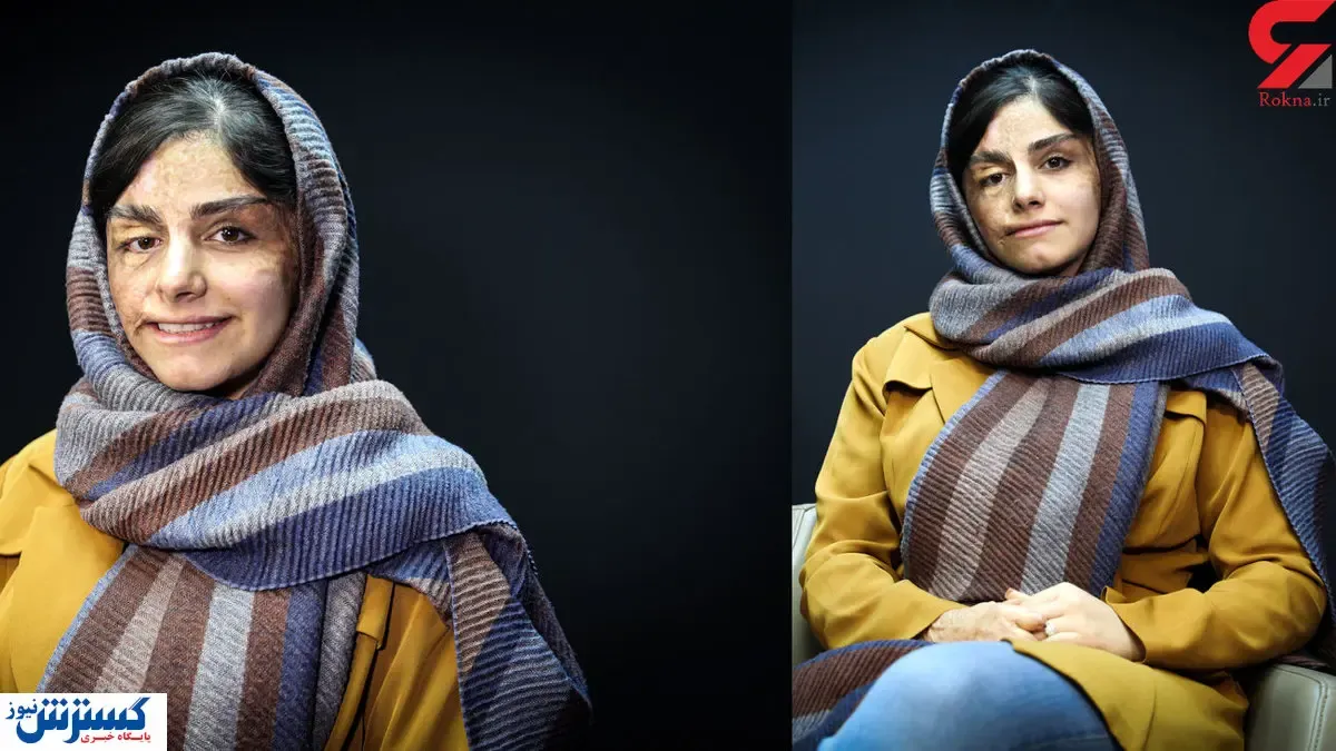 دختر نابغه ای که صورتش سوخت + تصاویر