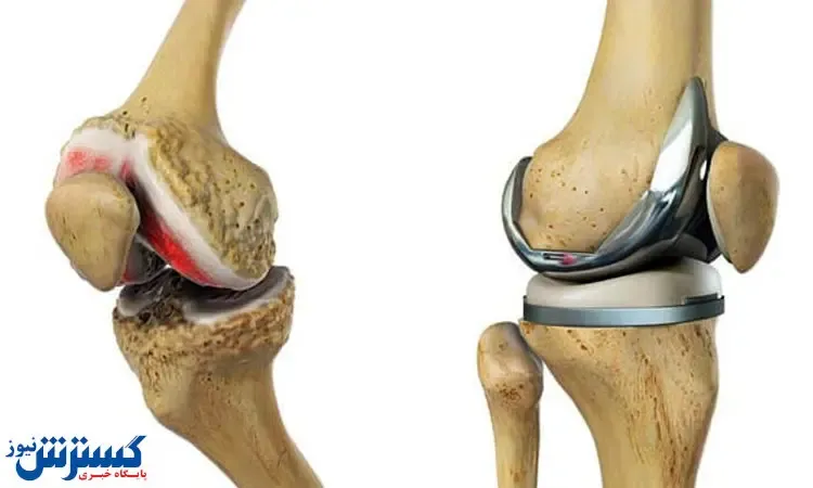 مقصر نبودن پروتز زانوو تجهیزات پزشکی کم کاری  بانک مرکزی است