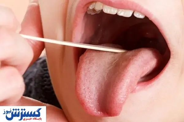 خشکی دهان را درمان کنید تا کرونا نگیرید