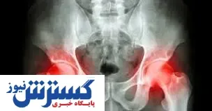 شایعترین علامت  سرطان لگن مشخص شد