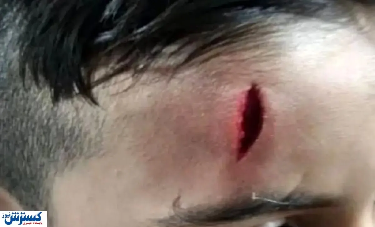 تنبیه وحشیانه یک دانش‌ آموز توسط معلم در خرم‌آباد! + عکس (۱۳+)