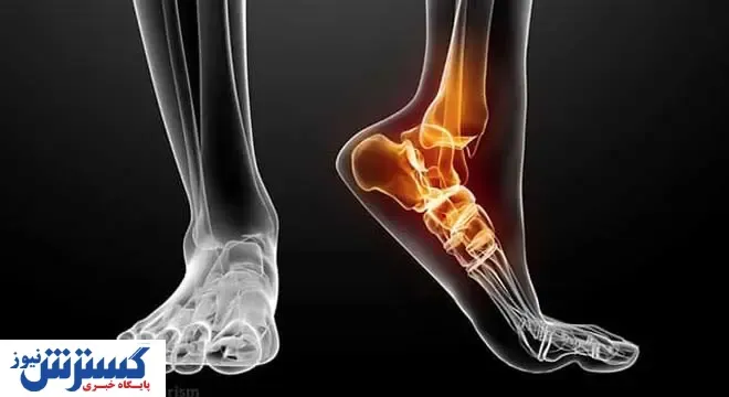 چرا مدام دچار پیچ خوردگی مچ پا می شویم؟