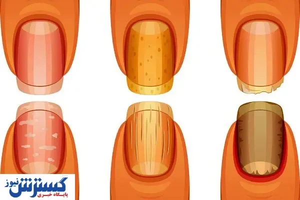 نشانه‌ هایی روی ناخن‌ ها که از سرطان خبر می ‌دهند!