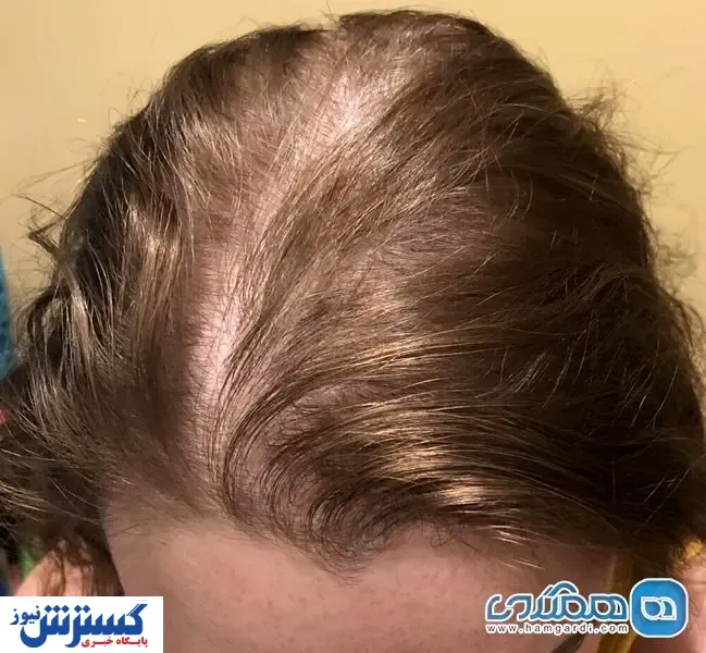 چرا خانم ها دچار ریزش مو می شوند؟