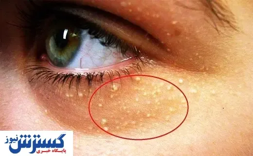 چشم‌ها ابتلا به این بیماری خطرناک را نشان می‌دهند