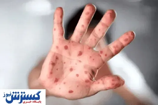 آبله میمون چگونه منتشر می شود؟