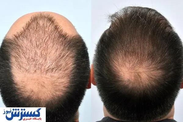 چه کسانی نمی توانند کاشت مو انجام دهند؟
