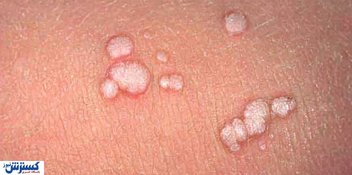 آیا زگیل تناسلی واگیر دارد؟ حقایق علمی درباره انتقال، پیشگیری و HPV