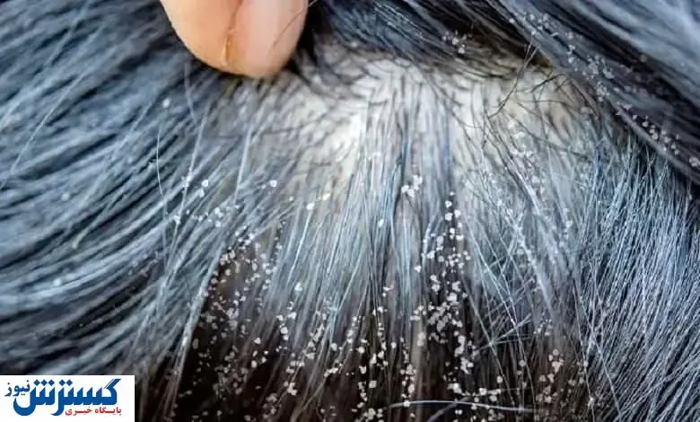 عجایب شگفت انگیز از آب برنج در درمان شپش