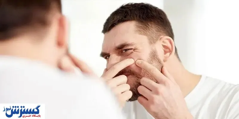 چند راهکار ساده برای از بین بردن جای جوش در خانه