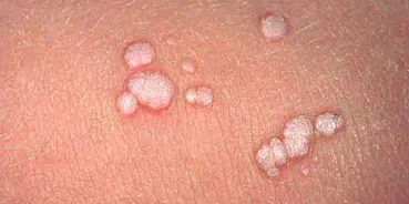 آیا زگیل تناسلی واگیر دارد؟ حقایق علمی درباره انتقال، پیشگیری و HPV