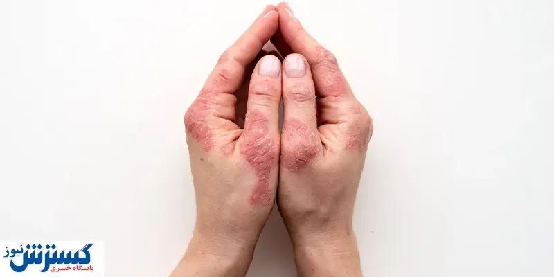 دلایل ابتلا به بیماری پوستی صدفک /هزینه درمان پسوریازیس گزاف است؟