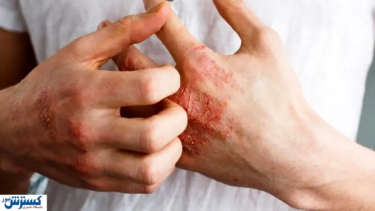 عارضه دردناک خارش پوست + درمان خانگی