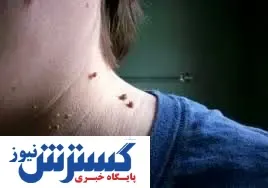نحوه درمان زگیل در خانه فوری و سریع | نسخه های طب سنتی