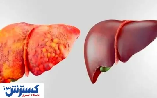 بیماری خطرناک کبد چرب با این علائم می آید