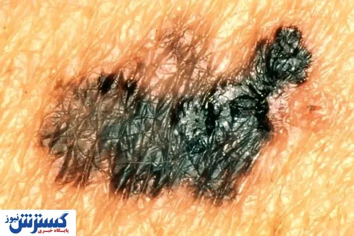 کدام خال‌ها نشانه‌ی سرطانند؟
