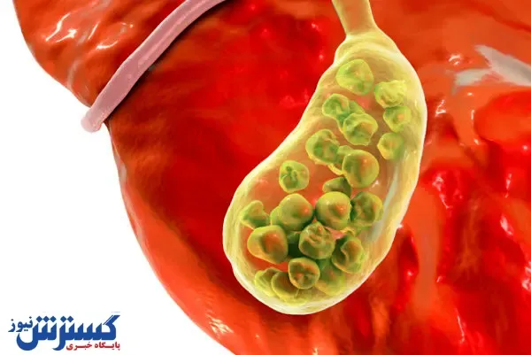 درباره درمان سنگ کیسه صفرا چه می‌دانید؟