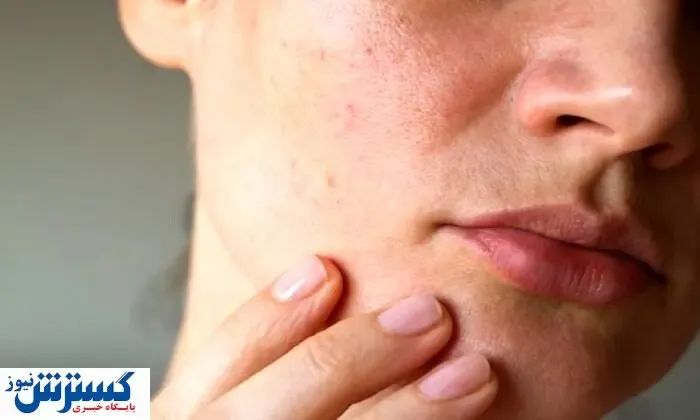 راهکار جلوگیری از شلی پوست بعد از لاغری