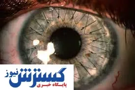 درمان نابینایی با سلولهای بنیادی