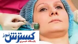 میکرونیدلینگ