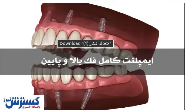 ایمپلنت کامل فک بالا و فک پایین
