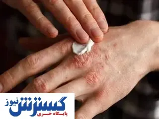 راهکار و روش هایی برای درمان اگزما + نکات مهم و کلیدی