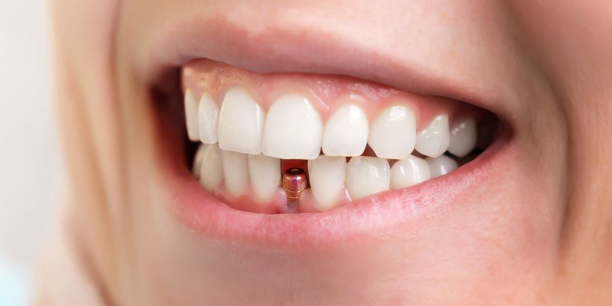 آشنایی با مراحل مختلف کاشت ایمپلنت دندان